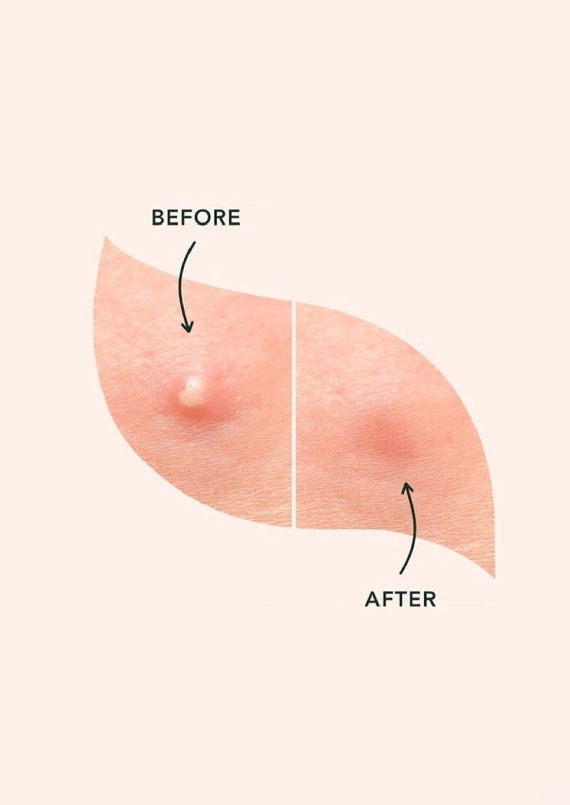 Acne Patch – 36 Hydrocolloid Patches | Overnight Pimple Healing Stickers