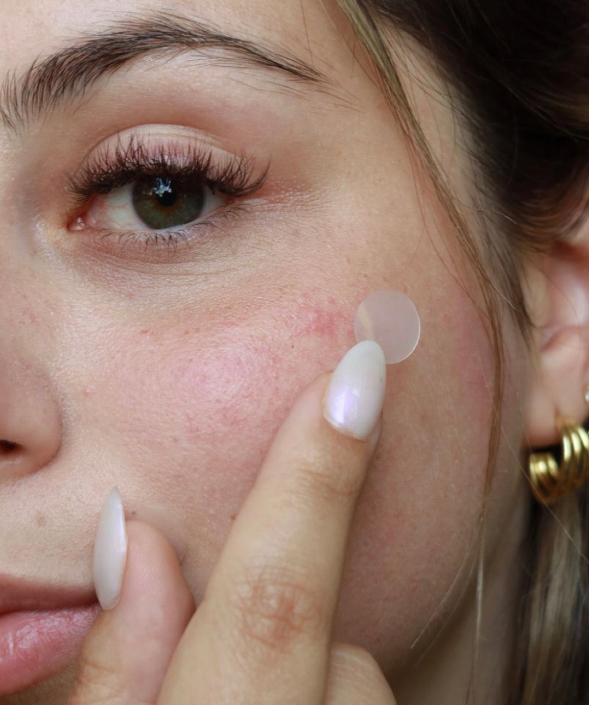 Acne Patch – 36 Hydrocolloid Patches | Overnight Pimple Healing Stickers